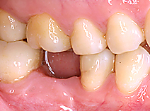 インプラント 治療前